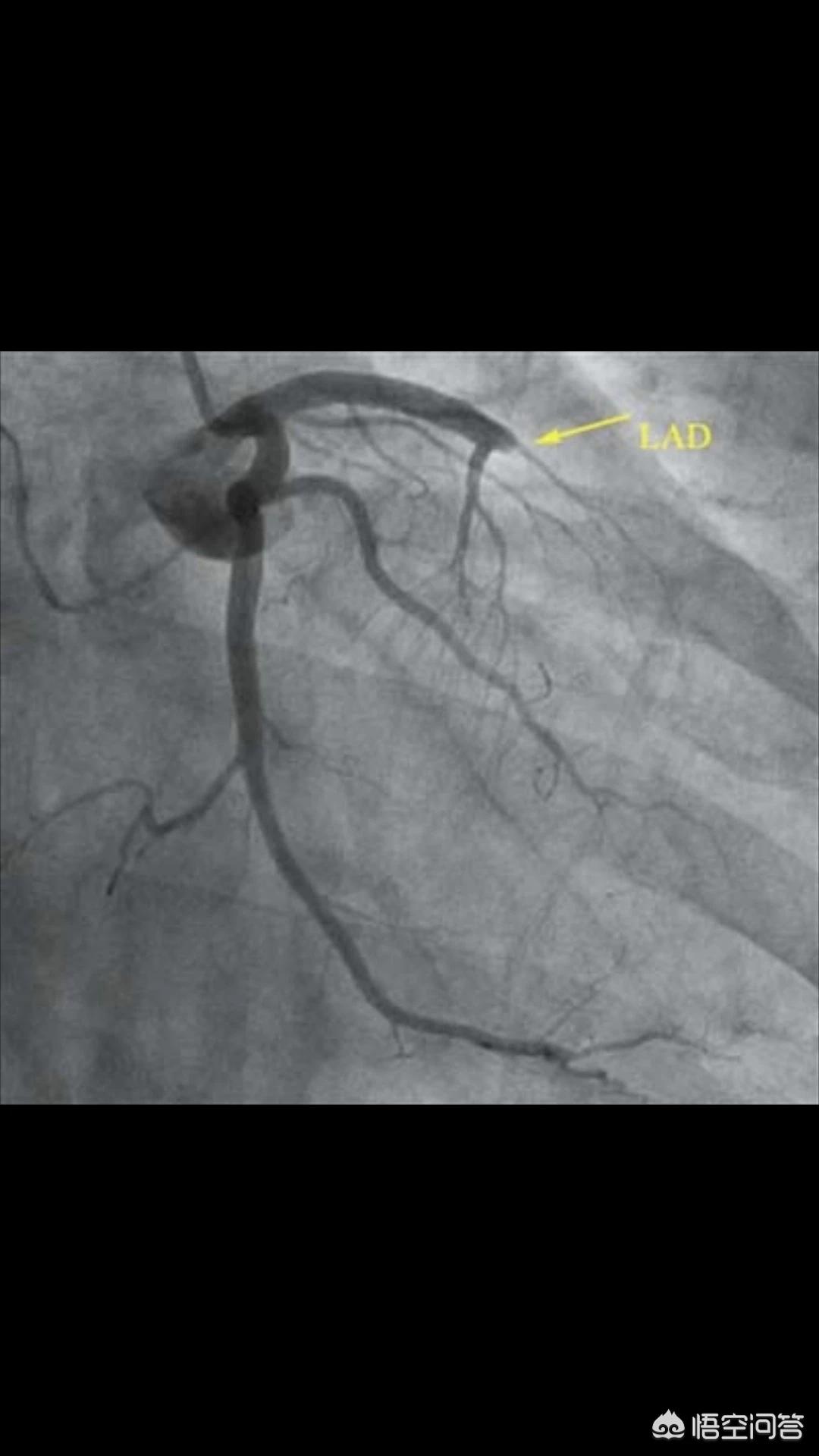 心脏有三根大血管，堵死一根还能正常工作吗？