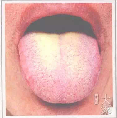 孩子舌苔白厚咳嗽,孩子舌苔白厚口臭