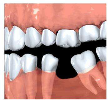缺了牙齿不补会怎么样,缺了一颗牙齿不种牙矫正可以吗