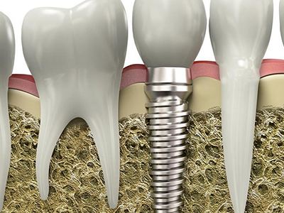 缺了牙齿不补会怎么样,缺了一颗牙齿不种牙矫正可以吗