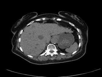 血管肉瘤的治疗方法,头皮恶性血管肉瘤治愈案例