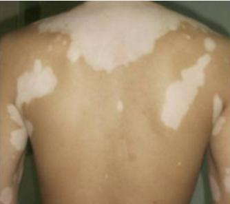 导演冯小刚的白癜风治好了吗,冯小刚在哪里治白癜风