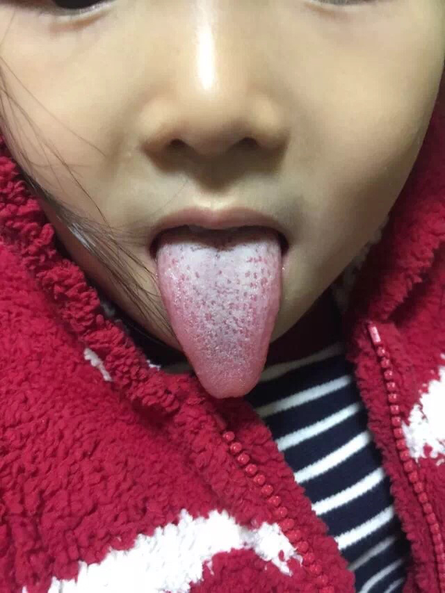 孩子舌苔白厚咳嗽,孩子舌苔白厚口臭