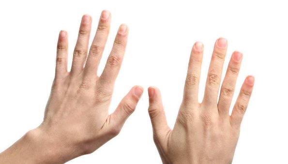 汗疱疹像是被火烫过,汗疱疹小水泡感觉里面有黑点