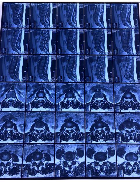 腰椎滑脱还有峡部裂怎么治疗,峡部裂型腰椎滑脱进展