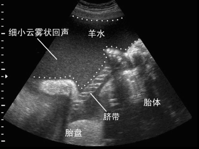 孕妈怀孕后羊水是怎样形成的,孕妈妈收藏