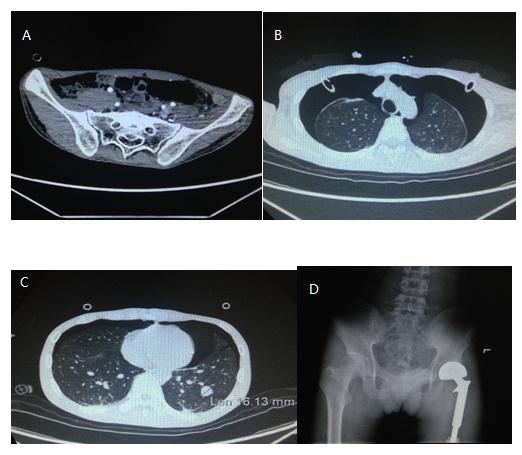 左胯骨内侧隐痛要当心,左肋骨隐隐痛要当心了