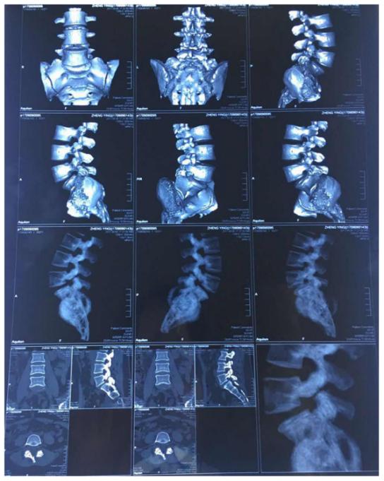腰椎滑脱还有峡部裂怎么治疗,峡部裂型腰椎滑脱进展