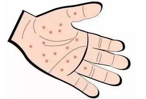 汗疱疹像是被火烫过,汗疱疹小水泡感觉里面有黑点