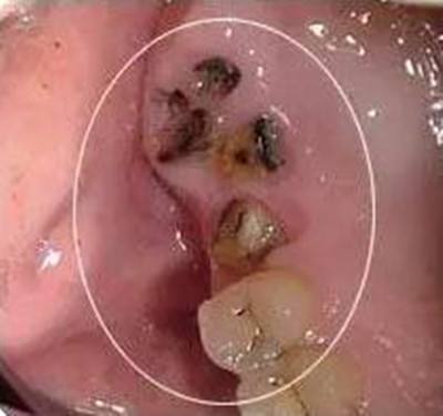 怀孕的时候牙病怎么办,怀孕期有牙病怎么办
