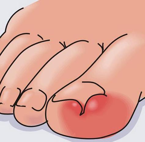 甲沟炎民间偏方用田螺可以吗,嵌甲性甲沟炎有什么偏方吗