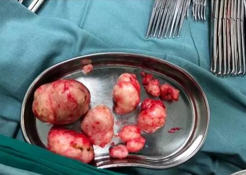 小肌瘤要看良性还是恶性么,子宫两个肌瘤多大需要剔除