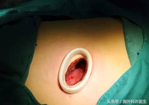 胸腔镜手术会很痛吗,胸腔镜手术很痛吗