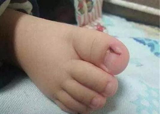 甲沟炎民间偏方用田螺可以吗,嵌甲性甲沟炎有什么偏方吗