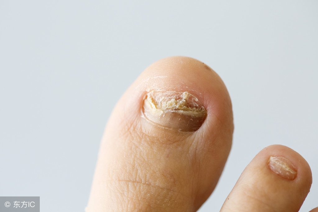 灰指甲怎么能避免传染,灰指甲怎么预防才能不被传染