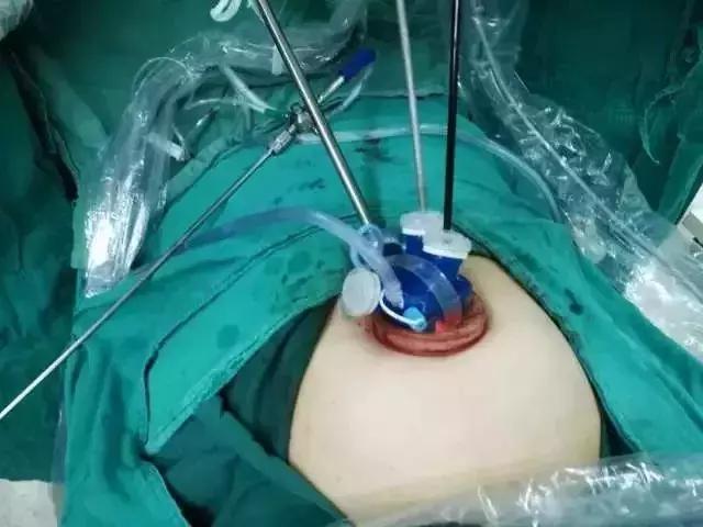 单孔腹腔镜术后伤口恢复图片,单孔腹腔镜肚脐伤口难愈合