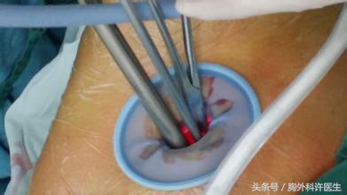 胸腔镜手术会很痛吗,胸腔镜手术很痛吗