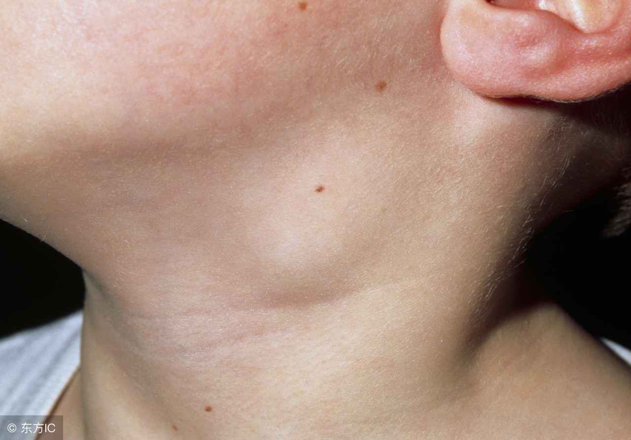 超声浅表淋巴结肿大的标准,颈部浅表淋巴结肿大