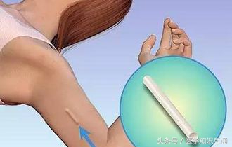 避孕方式排行榜，哪种女人最舒服最安全？