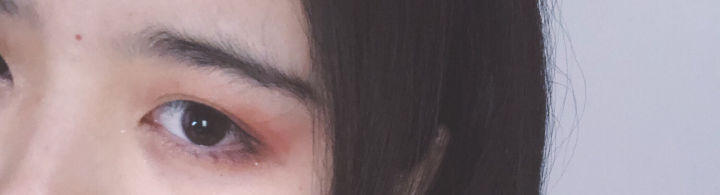 长在这8个部位的痣需要注意了,不要随便点痣的图片