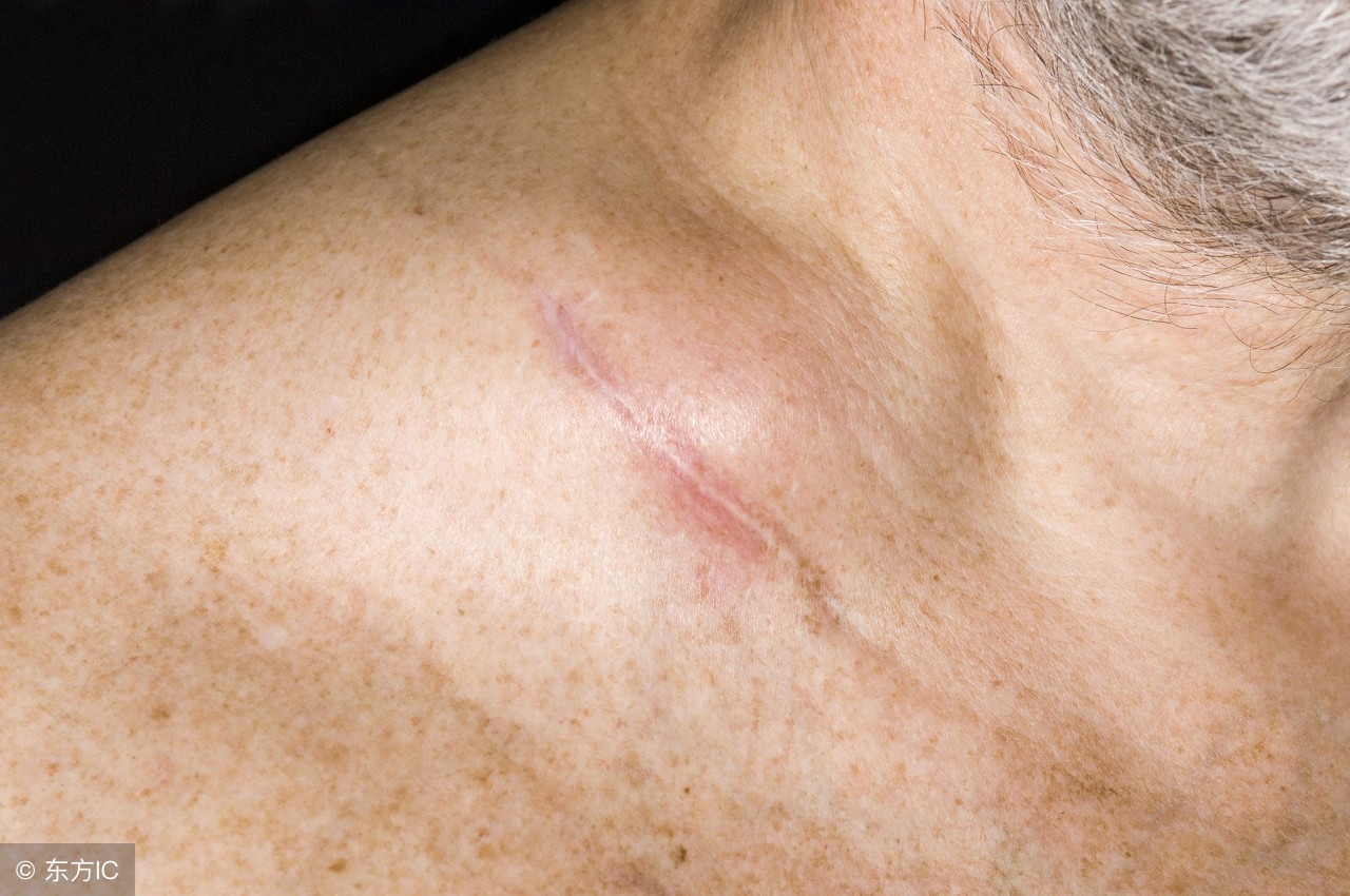 超声浅表淋巴结肿大的标准,颈部浅表淋巴结肿大