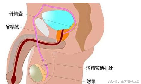 避孕方式排行榜，哪种女人最舒服最安全？