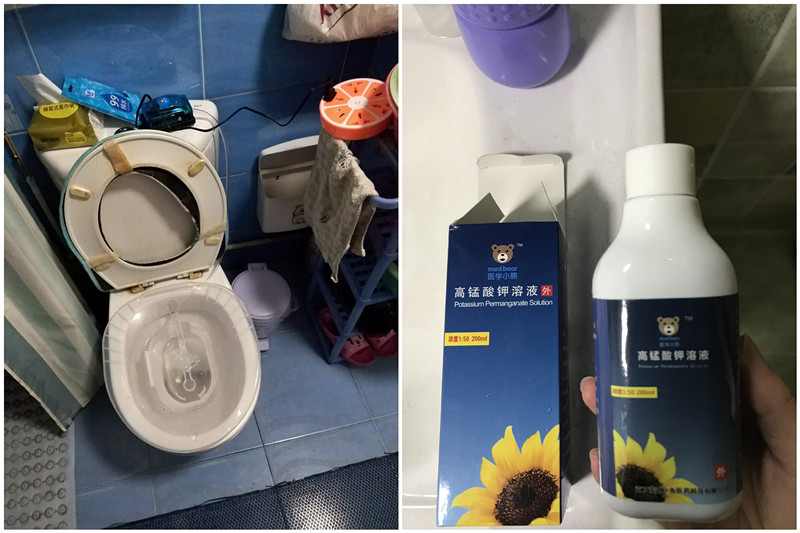 痔疮手术考验医生技术吗,痔疮微创手术患者真实感受上海