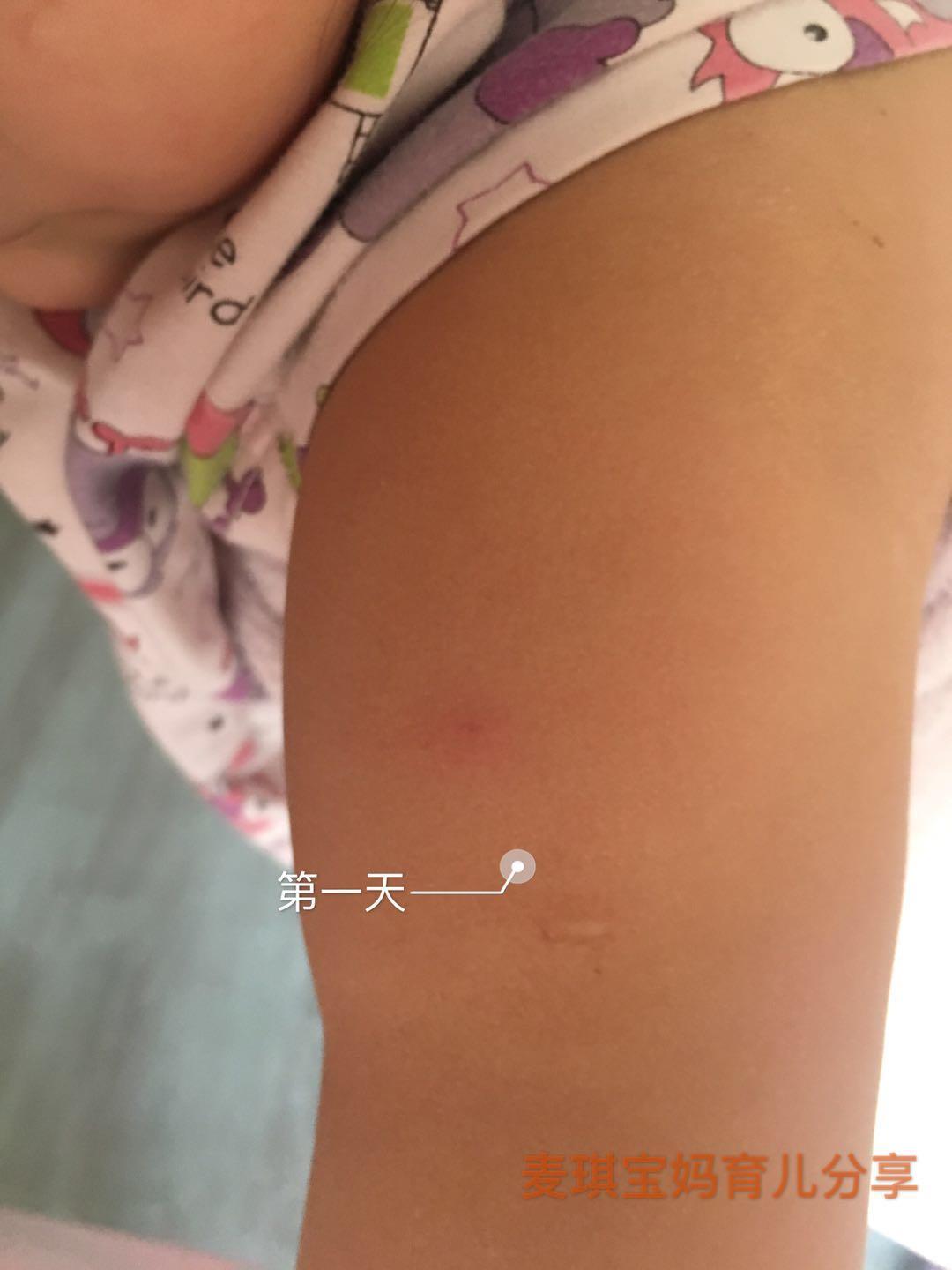 孩子打了百白破胳膊上有硬块,宝宝打完百白破胳膊肿了怎么回事