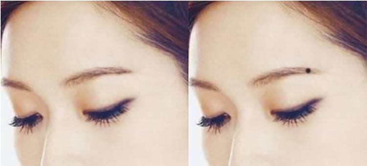 长在这8个部位的痣需要注意了,不要随便点痣的图片