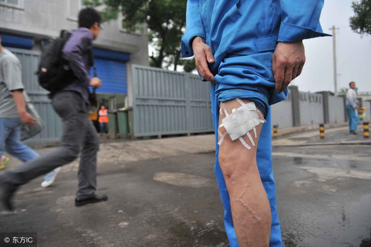 恐狂症与狂犬病的敏感区别,恐狂是什么