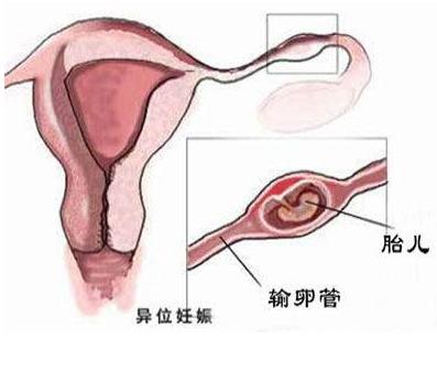 上环是避孕最好的方法吗？对身体会造成什么危害呢？