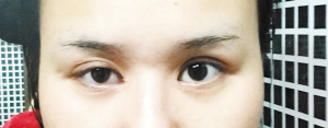 双眼皮割深了眼睛像青蛙眼一样,割双眼皮闭眼以后眼角有褶子