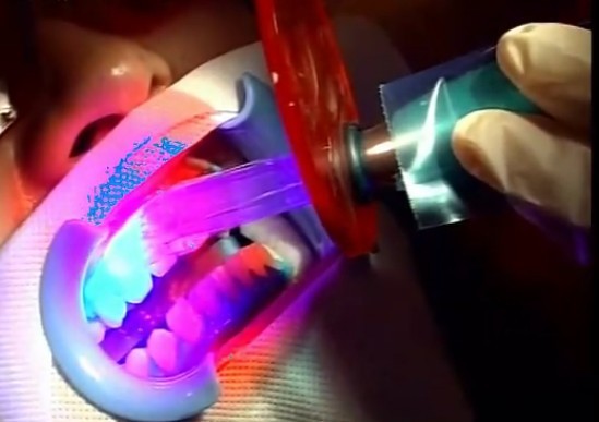 教你如何摆脱大黄牙,如何告别大黄牙