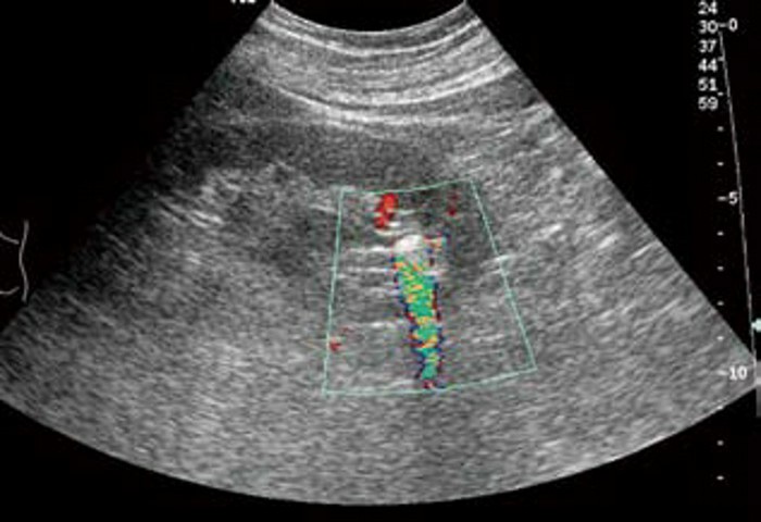 肾结石的超声图像,肾结石超声诊断及鉴别