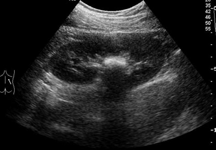 肾结石的超声图像,肾结石超声诊断及鉴别