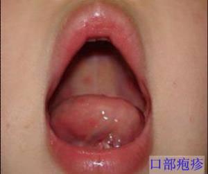 手足口病严重的有没有危险,手足口病第几天最危险