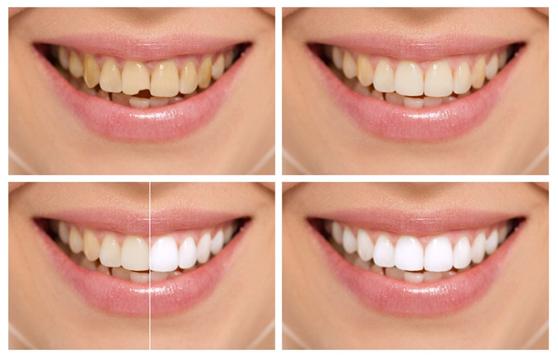 教你如何摆脱大黄牙,如何告别大黄牙