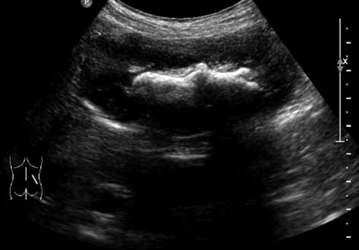 肾结石的超声图像,肾结石超声诊断及鉴别