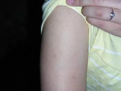 眼部毛周角化和鸡皮肤的区别,毛周角化就是鸡皮肤吗