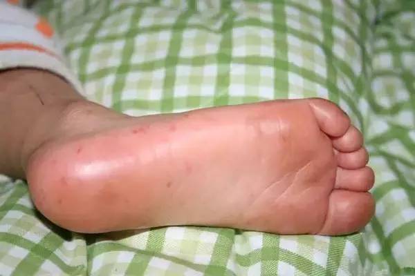 宝妈们注意手足口病防控知识,手足口病防治指南宝妈赶紧学起来