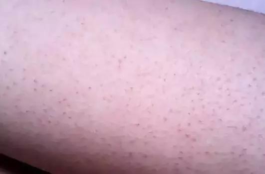 眼部毛周角化和鸡皮肤的区别,毛周角化就是鸡皮肤吗