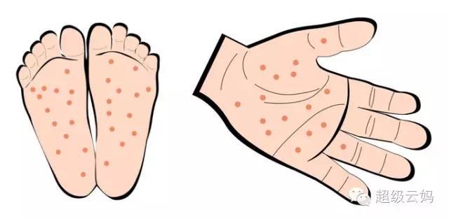 宝妈们注意手足口病防控知识,手足口病防治指南宝妈赶紧学起来