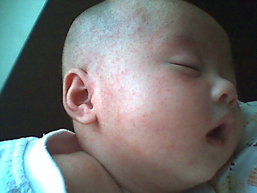 宝宝脸蛋红是湿疹的表现吗,婴儿脸上的奶癣反反复复怎么办