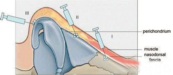 隆鼻的最佳方案,隆鼻的六种手段