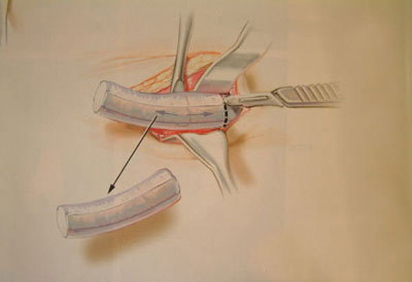 隆鼻的最佳方案,隆鼻的六种手段