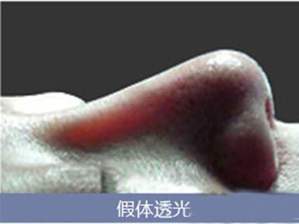 隆鼻的最佳方案,隆鼻的六种手段