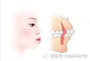 门牙怎么算前突,门牙前突怎么办最好最快的方法
