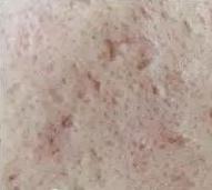 痘印的种类及成因,红色痘印成因