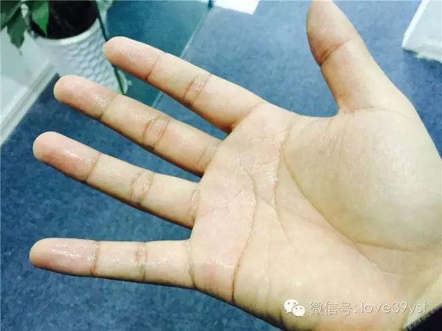 手上的青筋肿了怎么办,手血管突出青筋暴起是什么原因