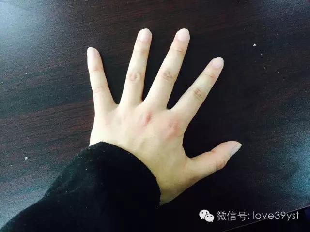 手上的青筋肿了怎么办,手血管突出青筋暴起是什么原因